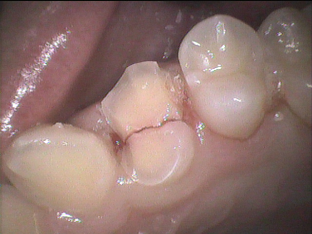 歯を抜かない治療｜歯根破折による抜歯から歯を守るなら香川県高松市の吉本歯科医院