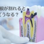 歯の根っこが割れるとどうなる？｜香川県高松市の吉本歯科医院