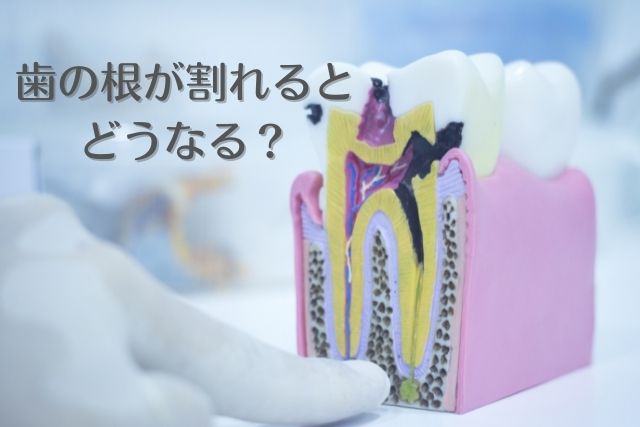 歯の根っこが割れるとどうなる？｜香川県高松市の吉本歯科医院