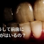前歯にヒビが入る原因｜咬み合わせ専門家が解説｜高松市 吉本歯科医院