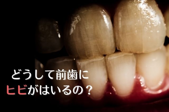 前歯にヒビが入る原因｜咬み合わせ専門家が解説｜高松市 吉本歯科医院