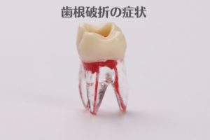 歯根破折の症状｜破折から歯を守る吉本歯科医院