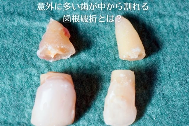 歯が中から折れる歯根破折｜歯を抜かない治療なら香川県高松市の吉本歯科医院