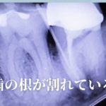 歯の根が割れている場合｜高松市の抜かない治療なら吉本歯科医院