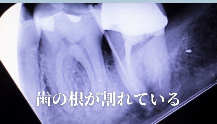 歯の根が割れている場合｜高松市の抜かない治療なら吉本歯科医院