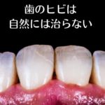 歯のヒビの治療｜香川県高松市の吉本歯科医院