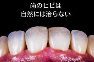 歯のヒビの治療｜香川県高松市の吉本歯科医院