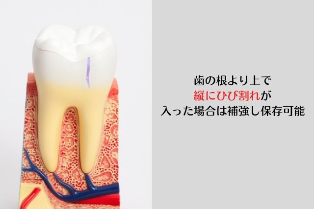 歯が縦に割れた場合は抜歯？｜香川県高松市の咬み合わせ専門歯科　吉本歯科医院