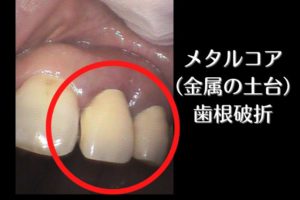 差し歯の土台が割れて抜歯診断｜歯根破折なら高松市の吉本歯科医院